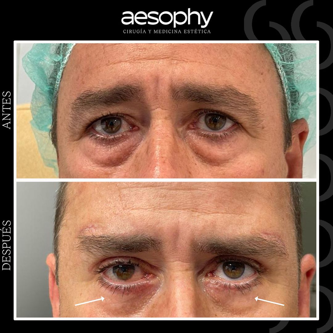 Blefaroplastia Málaga