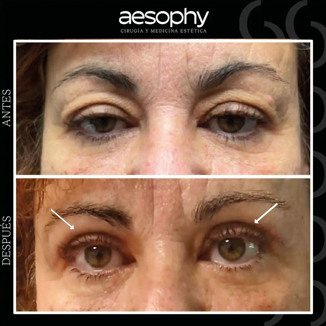 Blefaroplastia Málaga